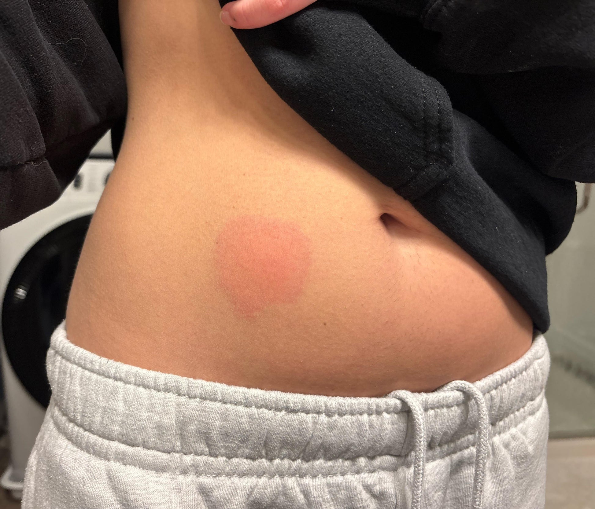 Red bump/mark at injection site? : r/Semaglutide